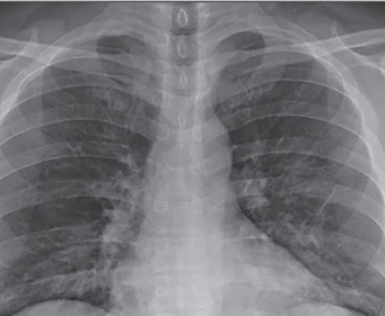 Почему не все пациенты с COVID-19 замечают пневмонию? Американский врач рассказал о «тихой» гипоксии – это очень важно
